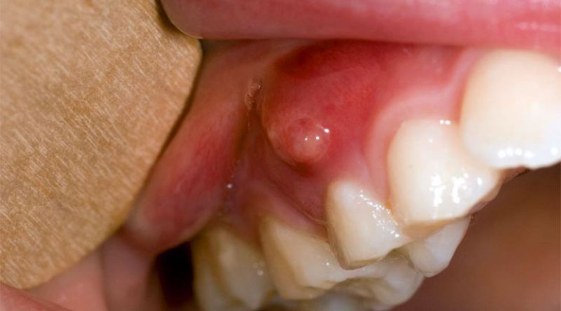 Ổ viêm mủ quanh chân răng hình thành do viêm tủy răng