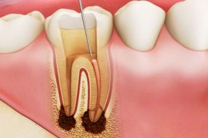 Viêm tủy răng có nguy hiểm không và cách xử lý khi bị bệnh