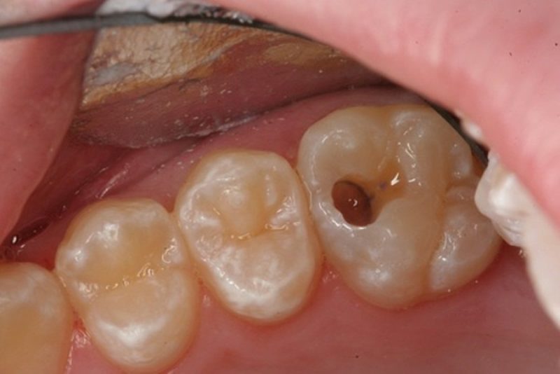 Viêm tủy răng hình thành do vi khuẩn xâm nhập qua lỗ sâu răng