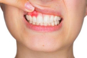 áp xe răng có nguy hiểm không