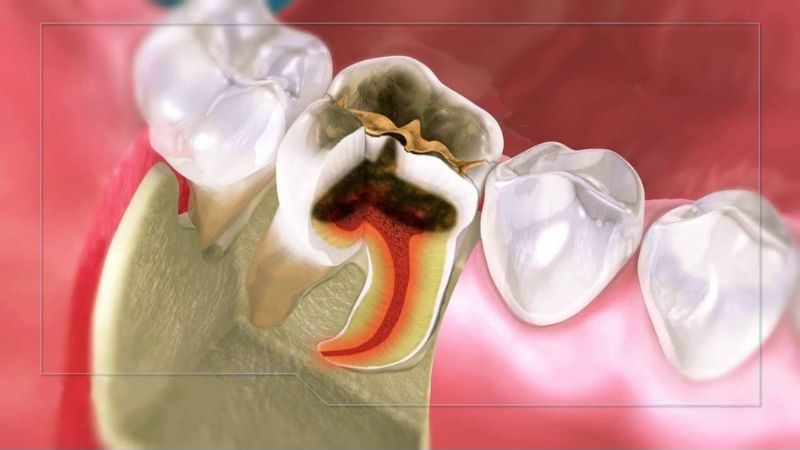 Viêm tủy răng có thể biến chứng nguy hiểm nếu không được điều trị triệt để