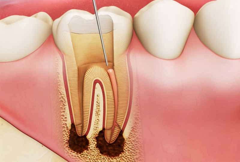 Người bị áp xe răng nặng cũng có thể được bác sĩ chỉ định điều trị tủy răng
