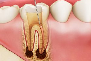 Cảnh báo nguy hiểm bệnh áp xe răng ở trẻ em và hướng dẫn điều trị