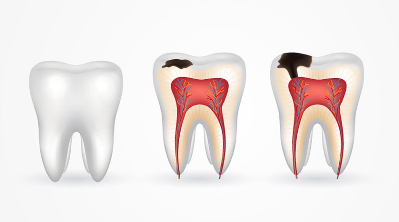 Quá trình sâu răng thường kéo dài từ 1 – 2 năm