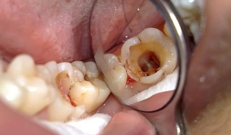 Sâu răng giai đoạn 4 phá hủy tủy răng nghiêm trọng
