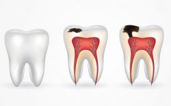 Quá trình sâu răng diễn biến khá phức tạp