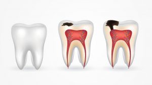 Quá trình sâu răng diễn biến khá phức tạp