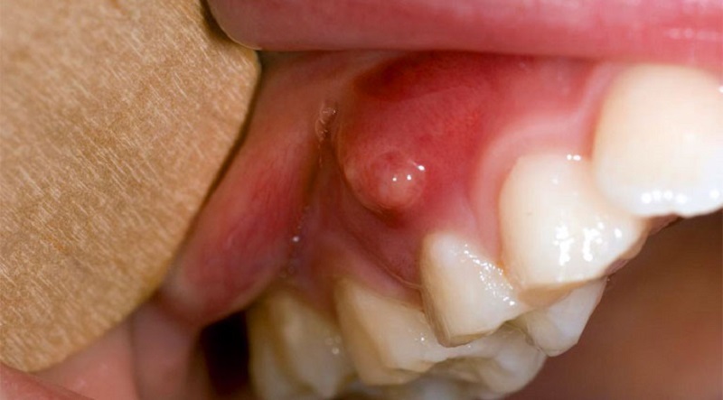 Áp xe răng là bệnh nhiễm trùng răng miệng khá nguy hiểm và cần điều trị kịp thời