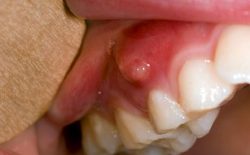 thuốc điều trị áp xe răng