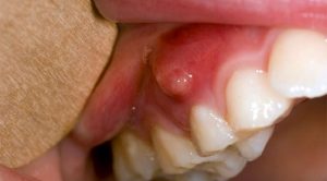 thuốc điều trị áp xe răng