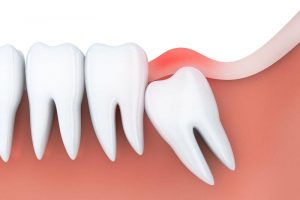 Viêm lợi trùm rất nguy hiểm nếu không được điều trị kịp thời