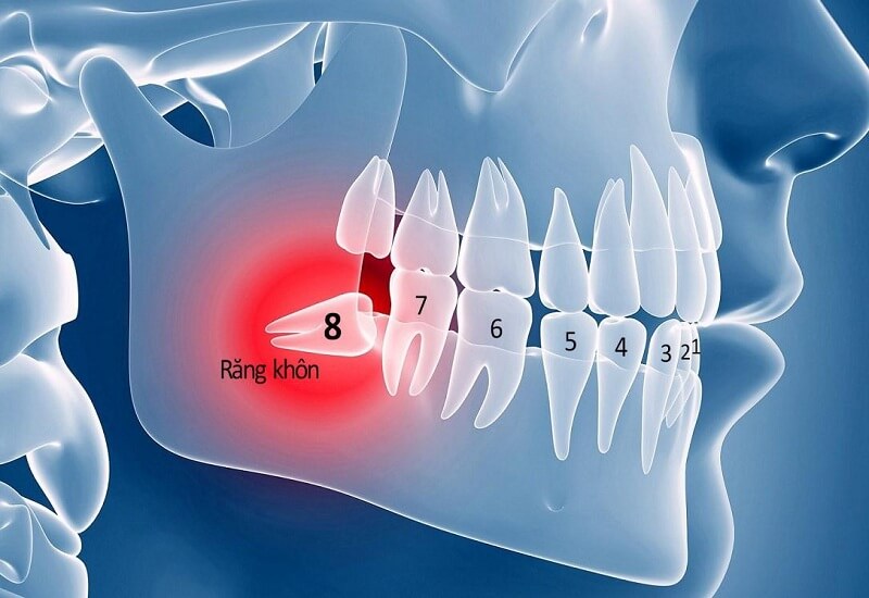 Trường hợp điều trị triệt để nhất là loại bỏ chiếc răng khôn mới nhú nếu mọc lệch