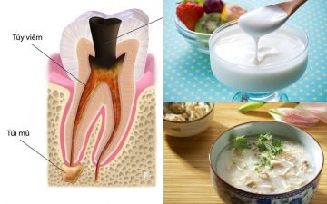 Viêm tủy răng nên ăn gì là vấn đề được nhiều người quan tâm