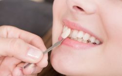 Quy trình thực hiện và giá dán răng sứ mới nhất