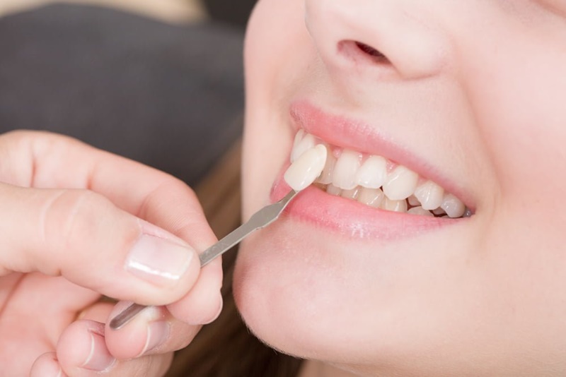 Dán răng sứ hay còn gọi là phương pháp sử dụng miếng sứ veneer