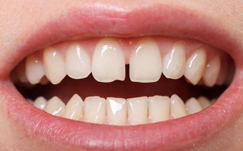 Trường hợp răng bị thưa có thể áp dụng phương pháp dán răng sứ
