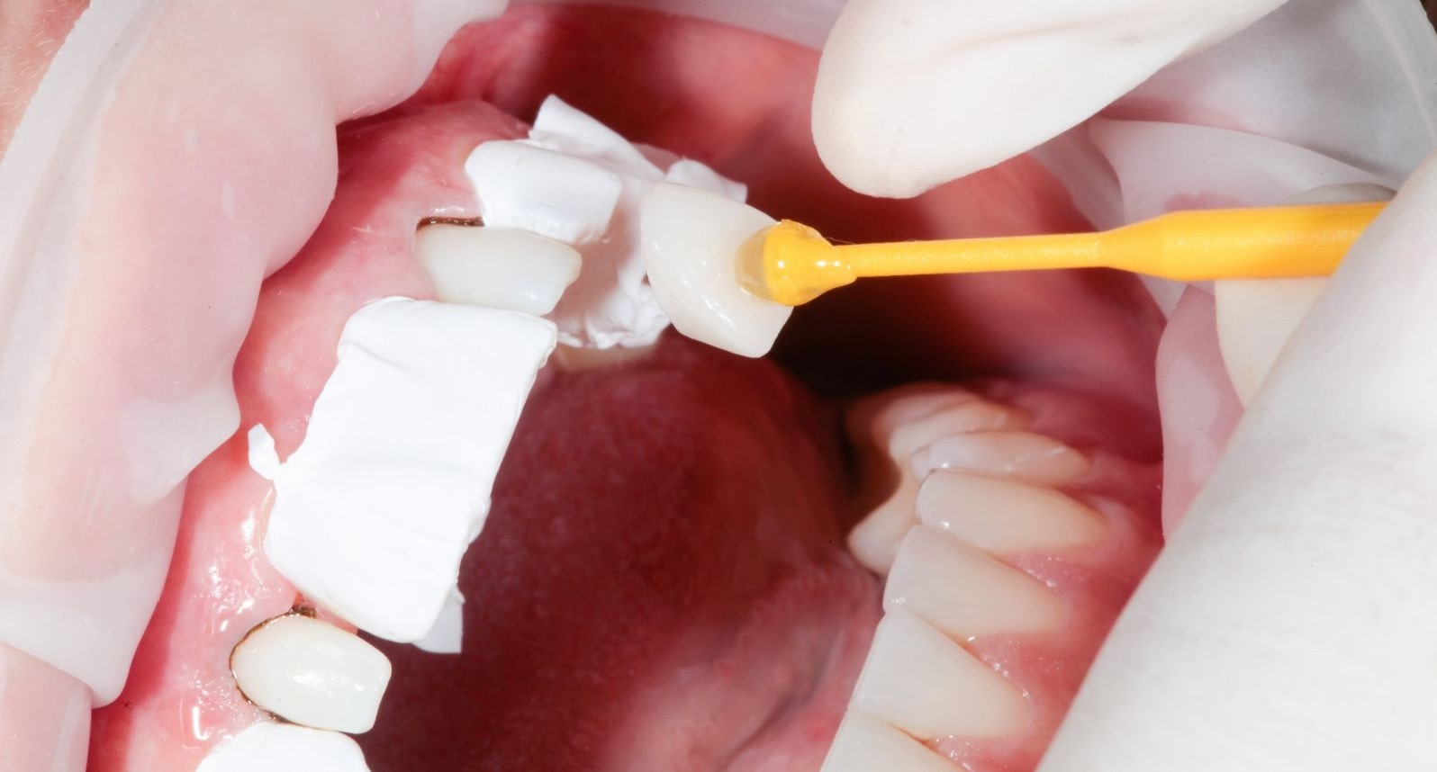 Quy trình thực hiện dán răng sứ thường bao gồm 5 bước