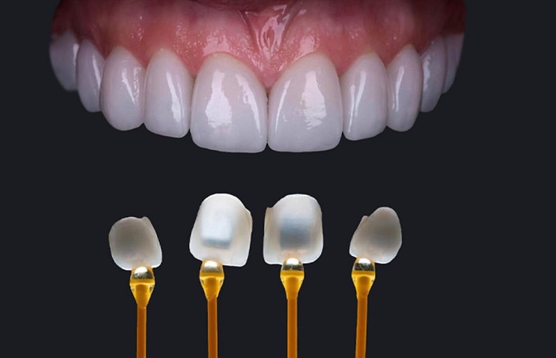 Quy trình dán răng sứ veneer bao gồm 5 bước chính