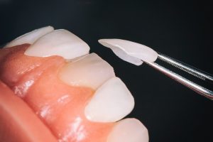 dán veneer