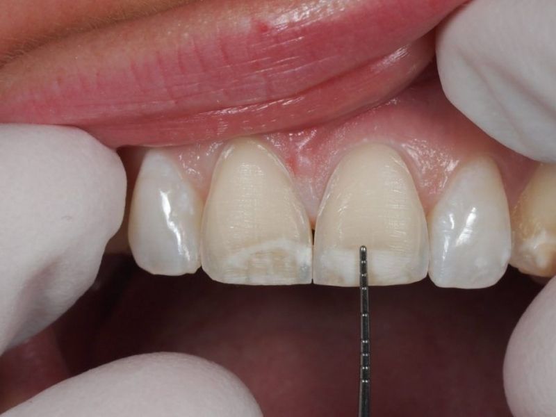Khi dán sứ Veneer bác sĩ sẽ chỉ cần mài một lớp rất mỏng trên bề mặt răng thật