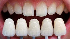 mặt dán sứ Veneer giá bao nhiêu