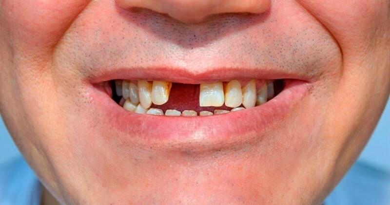 Mất răng khiến bạn gặp khó khăn trong việc ăn uống hàng ngày
