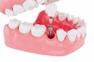 Giải đáp những thông tin cần biết về trồng răng implant