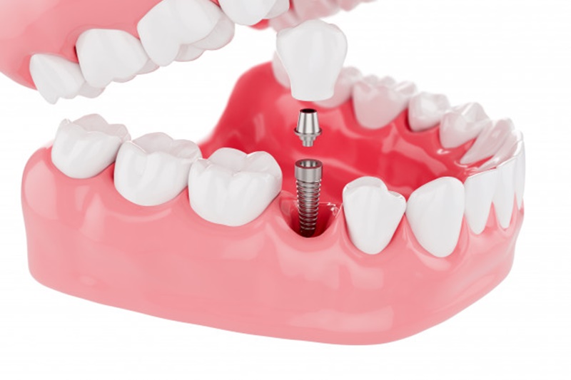 Trồng răng implant là phương pháp giúp khôi phục tình trạng mất một hoặc nhiều răng hiện đại