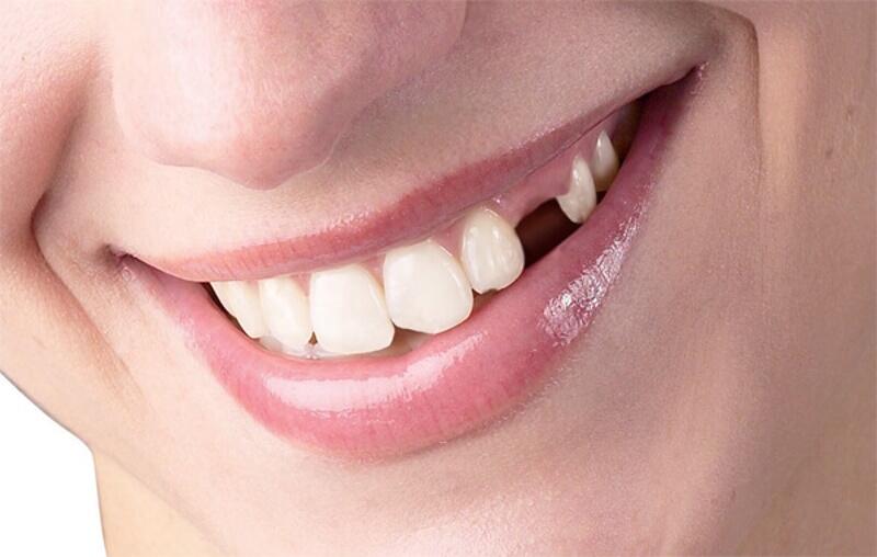 Người bị mất một hoặc nhiều răng có thể áp dụng phương pháp trồng răng implant