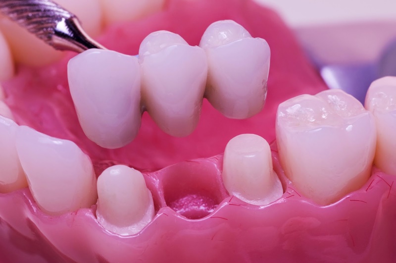 Trồng răng sứ có đau không phụ thuộc vào phương pháp thực hiện