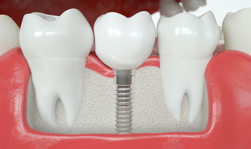 Trồng răng sứ cố định là phương pháp phục hình, thay thế răng đã mất