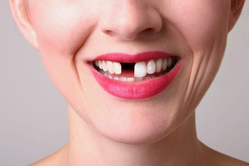 Chi phí trồng răng sứ phụ thuộc vào phương pháp thực hiện và số lượng răng