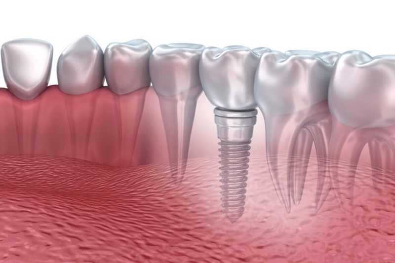 So với phương pháp cầu răng sứ, cấy ghép implant có chi phí thực hiện cao hơn