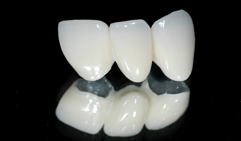 Răng sứ kim loại có giá thành thấp nhưng dễ dẫn đến tình trạng đen viền nướu.
