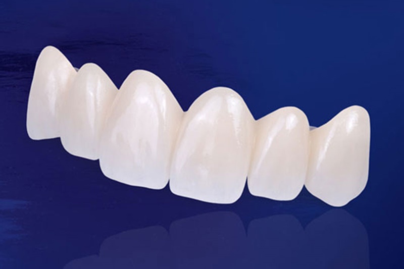 Răng toàn sứ có tuổi thọ cao hơn và không bị đen viền nướu.