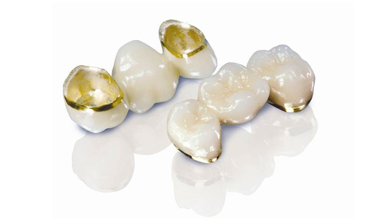 Răng sứ kim loại quý thường có chi phí cao hơn so với các loại răng sứ khác