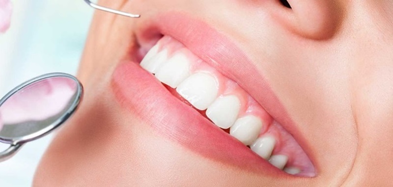 Răng toàn sứ có tính thẩm mỹ cao, màu sắc như răng thật