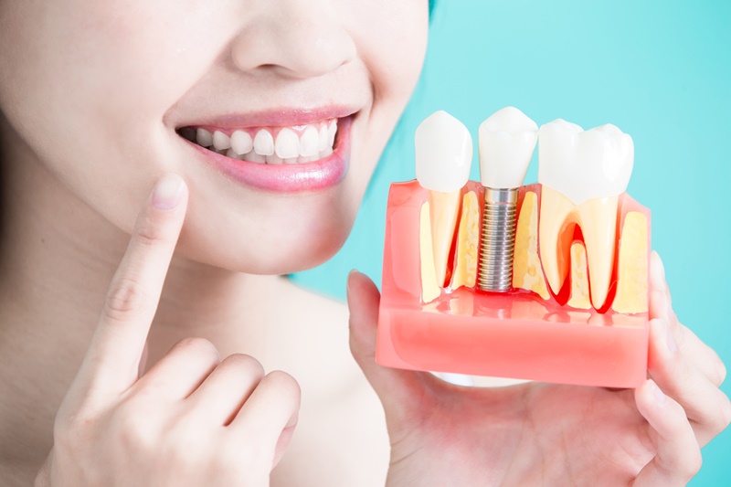 Trồng răng sứ nguyên hàm bằng phương pháp cố định implant