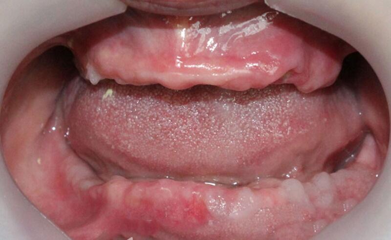 Mất răng lâu ngày có thể dẫn đến tiêu xương hàm
