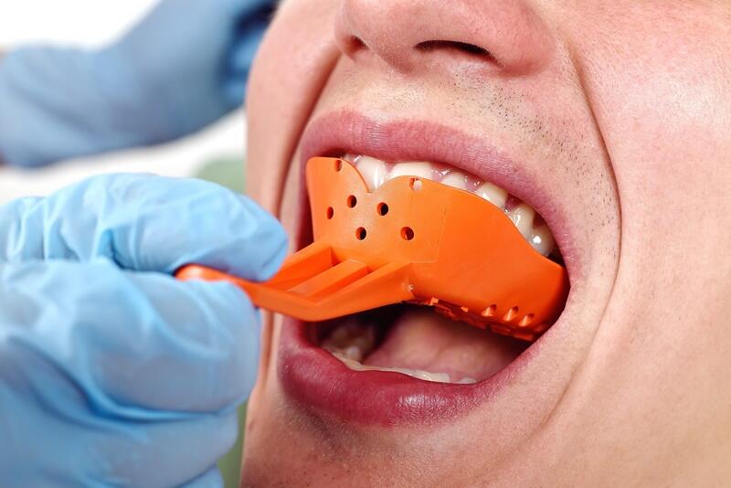Công đoạn lấy dấu hàm răng