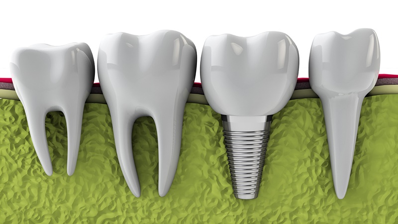 Trồng răng sứ bằng cấy ghép implant