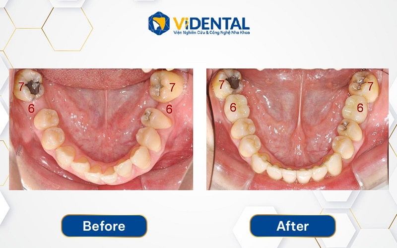 Trồng răng cho một trường hợp mất răng lâu khiến xươngTrồng răng hàm