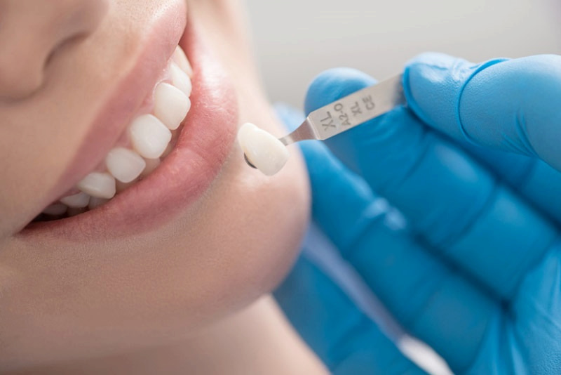 Trồng răng sứ nguyên hàm - Giải pháp an toàn, đáp ứng tính thẩm mỹ cho răng.