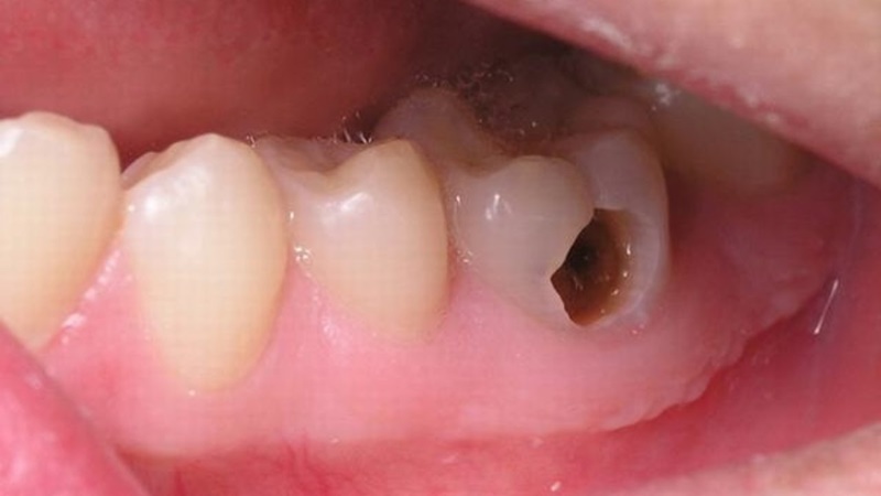 Răng sâu dẫn đến chết tủy có thể áp dụng trồng răng sứ vĩnh viễn
