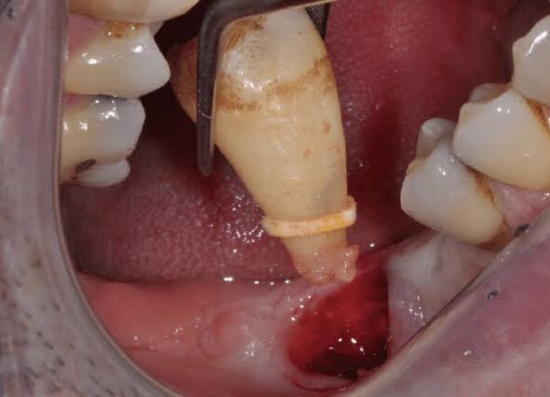 Lỗ hổng sau nhổ răng khôn là điều bình thường hậu phẫu