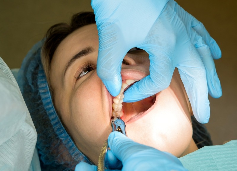 Nhổ răng số 8 để đảm bảo sức khỏe toàn hàm