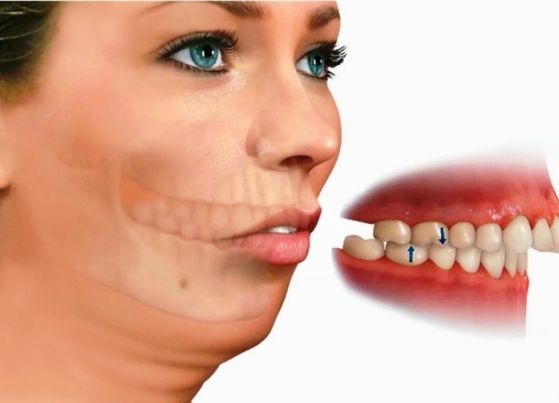 Niềng răng và phẫu thuật hàm kết hợp trong trường hợp hô móm phức tạp