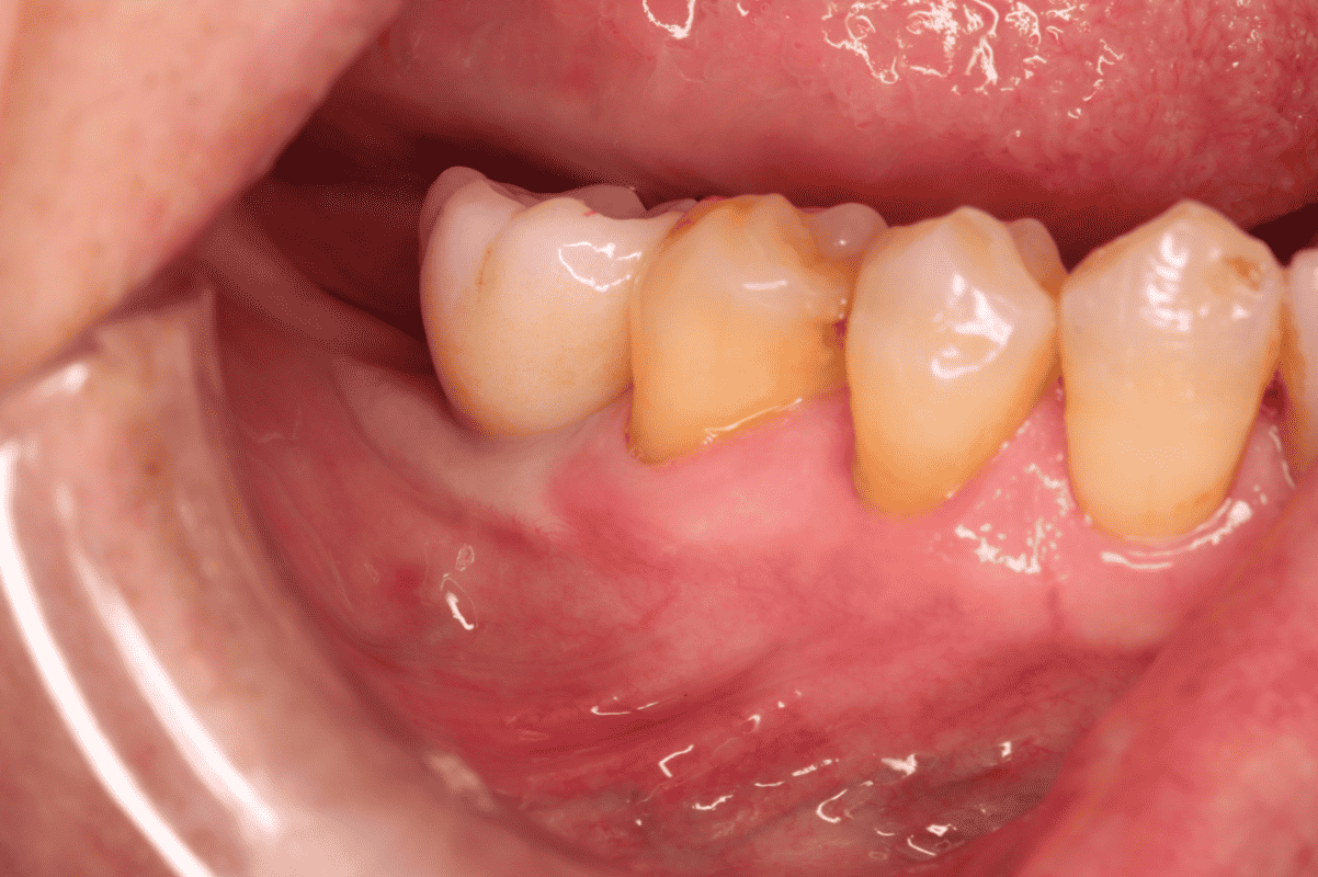 trồng răng implant